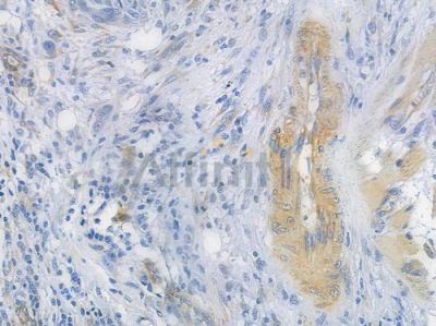 CHOP Recombinant Rabbit mAb - BF3176 at 1/100 staining human tongue carcinoma by IHC-P.