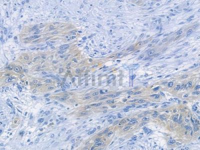 Src Recombinant Rabbit mAb - BF3182 at 1/100 staining human tongue carcinoma by IHC-P.