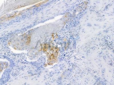 CXCR4 Recombinant Rabbit mAb - BF3186 at 1/100 staining human pancreatic carcinoma by IHC-P.