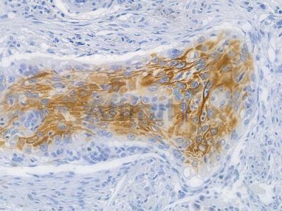 CXCR4 Recombinant Rabbit mAb - BF3186 at 1/100 staining human tongue carcinoma by IHC-P.