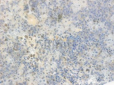 NG2 Recombinant Rabbit mAb - BF3200 at 1/100 staining human melanoma by IHC-P.