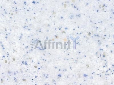 PSD95 Recombinant Rabbit mAb - BF3202 at 1/100 staining human astrocytoma by IHC-P.