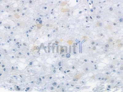 NOX4 Recombinant Rabbit mAb - BF3211 at 1/100 staining human astrocytoma by IHC-P.