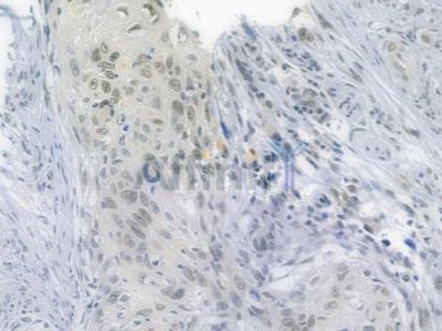 NOX4 Recombinant Rabbit mAb - BF3211 at 1/100 staining human tongue carcinoma by IHC-P.