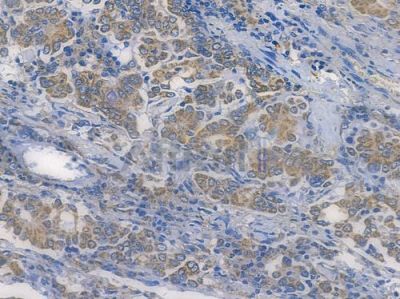 SOD2/MnSOD Recombinant Rabbit mAb - BF3212 at 1/100 staining human lung adenocarcinoma by IHC-P.