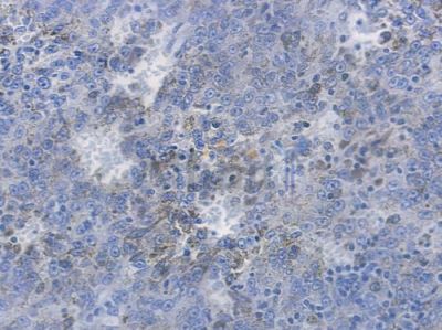 Phospho-4E-BP1 (Thr45) Recombinant Rabbit mAb - BF3215 at 1/100 staining human melanoma by IHC-P.