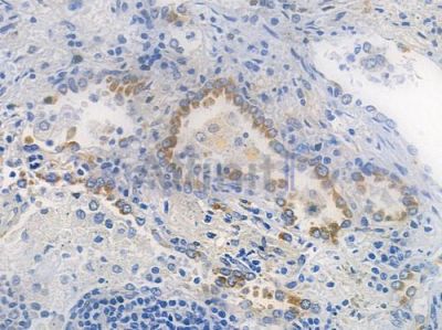 PTEN Recombinant Rabbit mAb - BF3216 at 1/100 staining human lung squamous cell carcinoma by IHC-P.