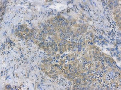 CALR Recombinant Rabbit mAb - BF3219 at 1/100 staining human esophageal carcinoma by IHC-P.