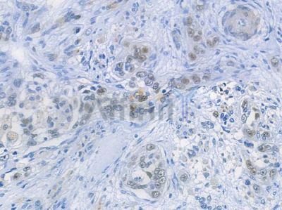 Phospho-p53 (Ser392) Recombinant Rabbit mAb - BF3230 at 1/100 staining human tongue carcinoma by IHC-P.