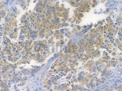 Phospho-eIF2 alpha (Ser51) Recombinant Rabbit mAb - BF3233 at 1/100 staining human lung squamous cell carcinoma by IHC-P.