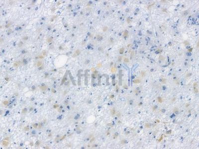 GRP78 Recombinant Rabbit mAb - BF3235 at 1/100 staining human astrocytoma by IHC-P.