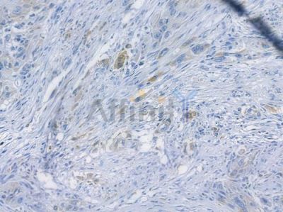 GRP78 Recombinant Rabbit mAb - BF3235 at 1/100 staining human tongue carcinoma by IHC-P.