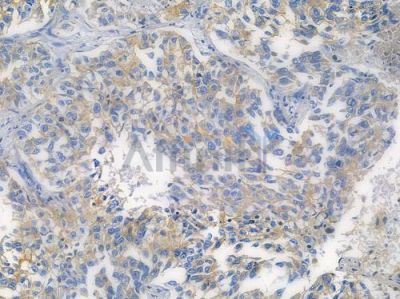 TIMP1 Recombinant Rabbit mAb - BF3238 at 1/100 staining human lung squamous cell carcinoma by IHC-P.