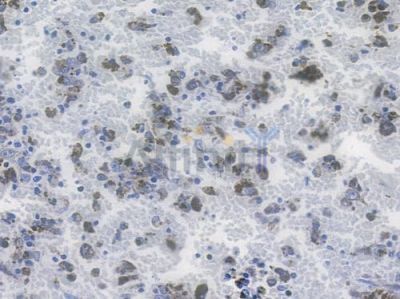 Mitofusin 2 Recombinant Rabbit mAb - BF3245 at 1/100 staining human melanoma by IHC-P.