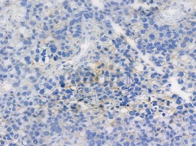 Phospho-FOXO3A (Ser253) Recombinant Rabbit mAb - BF3248 at 1/100 staining human glioblastoma by IHC-P.