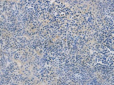 Integrin beta 1 Recombinant Rabbit mAb - BF3249 at 1/100 staining human thymoma by IHC-P.
