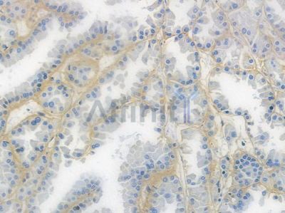Integrin beta 1 Recombinant Rabbit mAb - BF3249 at 1/100 staining human renal cell carcinoma by IHC-P.
