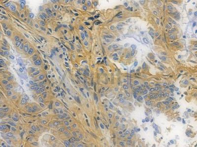 Integrin beta 1 Recombinant Rabbit mAb - BF3249 at 1/100 staining human lung adenocarcinoma by IHC-P.