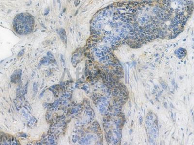 Integrin beta 1 Recombinant Rabbit mAb - BF3249 at 1/100 staining human breast carcinoma by IHC-P.