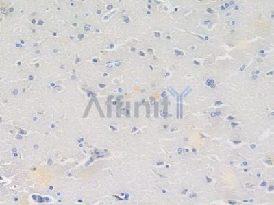 CaMKII Recombinant Rabbit mAb - BF3257 at 1/100 staining human glioblastoma by IHC-P.