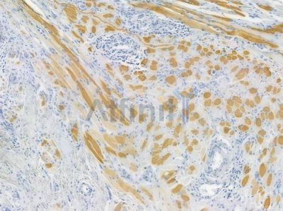 MLC2 Recombinant Rabbit mAb - BF3281 at 1/100 staining human tongue carcinoma by IHC-P.
