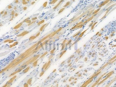 MLC2 Recombinant Rabbit mAb - BF3281 at 1/100 staining human tongue carcinoma by IHC-P.