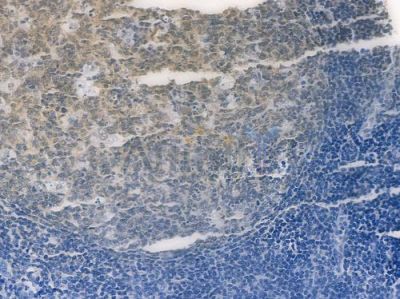 Phospho-MDM2 (Ser166) Recombinant Rabbit mAb - BF3284 at 1/100 staining human tongue carcinoma by IHC-P.