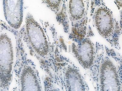 Phospho-MDM2 (Ser166) Recombinant Rabbit mAb - BF3284 at 1/100 staining human colon carcinoma by IHC-P.