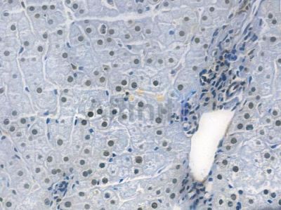 Phospho-MDM2 (Ser166) Recombinant Rabbit mAb - BF3284 at 1/100 staining human hepatocellular carcinoma by IHC-P.