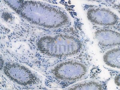 Phospho-MDM2 (Ser166) Recombinant Rabbit mAb - BF3284 at 1/100 staining human colon carcinoma by IHC-P.