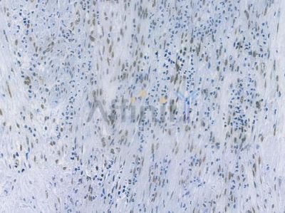 Phospho-MDM2 (Ser166) Recombinant Rabbit mAb - BF3284 at 1/100 staining human prostate carcinoma by IHC-P.