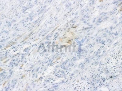 BMAL1 Recombinant Rabbit mAb - BF3291 at 1/100 staining human tongue carcinoma by IHC-P.