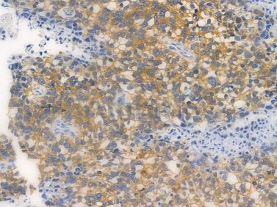 Phospho-MAP2 (Ser136) Recombinant Rabbit mAb - BF3298 at 1/100 staining human glioblastoma by IHC-P.