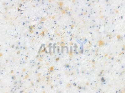 Phospho-MAP2 (Ser136) Recombinant Rabbit mAb - BF3298 at 1/100 staining human astrocytoma by IHC-P.