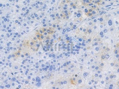IL33 Recombinant Rabbit mAb - BF3301 at 1/100 staining human hepatocellular carcinoma by IHC-P.