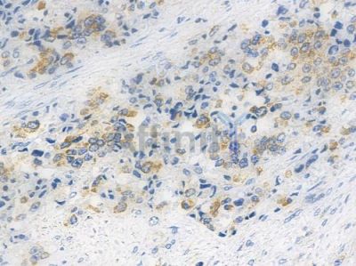 SYK Recombinant Rabbit mAb - BF3312 at 1/100 staining human prostate carcinoma by IHC-P.
