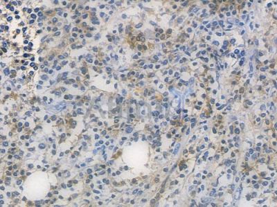 STAT5A Recombinant Rabbit mAb - BF3314 at 1/100 staining human Hodgkin lymphoma by IHC-P.