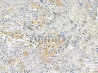 SOD1 Recombinant Rabbit mAb - BF3327 at 1/100 staining human tongue carcinoma by IHC-P.