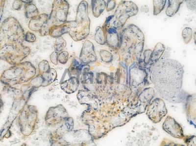 VEGFR1 Recombinant Rabbit mAb - BF3328 at 1/100 staining human lung squamous cell carcinoma sections by IHC-P.