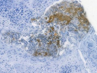 TAK1 Recombinant Rabbit mAb - BF3340 at 1/100 staining human esophageal carcinoma by IHC-P.