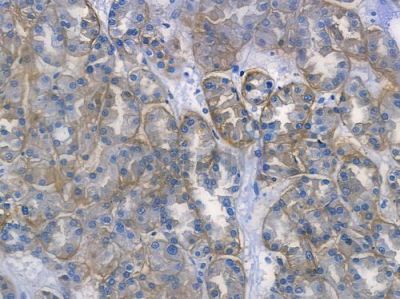 Integrin beta3 Recombinant Rabbit mAb - BF3342 at 1/100 staining human colon carcinoma by IHC-P.