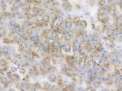 IRF5 Recombinant Rabbit mAb - BF3350 at 1/100 staining human renal cell carcinoma by IHC-P.