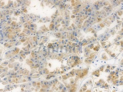 IRF5 Recombinant Rabbit mAb - BF3350 at 1/100 staining human renal cell carcinoma by IHC-P.