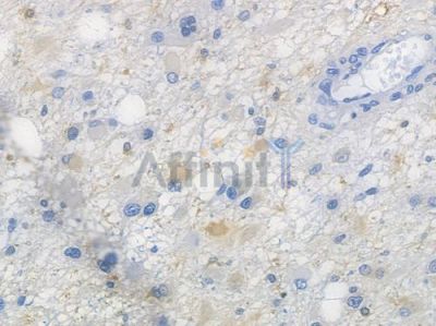 FGF21 Recombinant Rabbit mAb - BF3354 at 1/100 staining human astrocytoma by IHC-P.