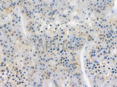 MST1/STK4 Recombinant Rabbit mAb - BF3360 at 1/100 staining human hepatocellular carcinoma by IHC-P.