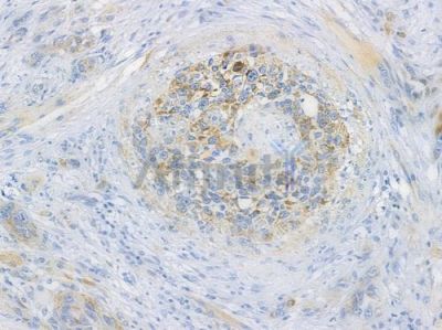 LAMP2 Recombinant Rabbit mAb - BF3362 at 1/100 staining human tongue carcinoma by IHC-P.