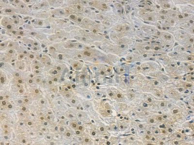 Phospho-CDK2 (Tyr15) Recombinant Rabbit mAb - BF3365 at 1/100 staining human hepatocellular carcinoma by IHC-P.