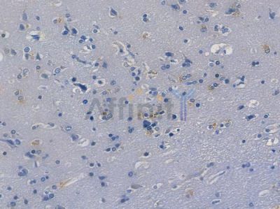 Phospho-CDK2 (Tyr15) Recombinant Rabbit mAb - BF3365 at 1/100 staining human glioblastoma by IHC-P.