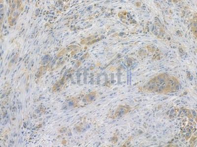 Cofilin Recombinant Rabbit mAb - BF3378 at 1/100 staining human tongue carcinoma by IHC-P.