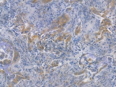 GCN2 Recombinant Rabbit mAb - BF3380 at 1/100 staining human lung adenocarcinoma by IHC-P.